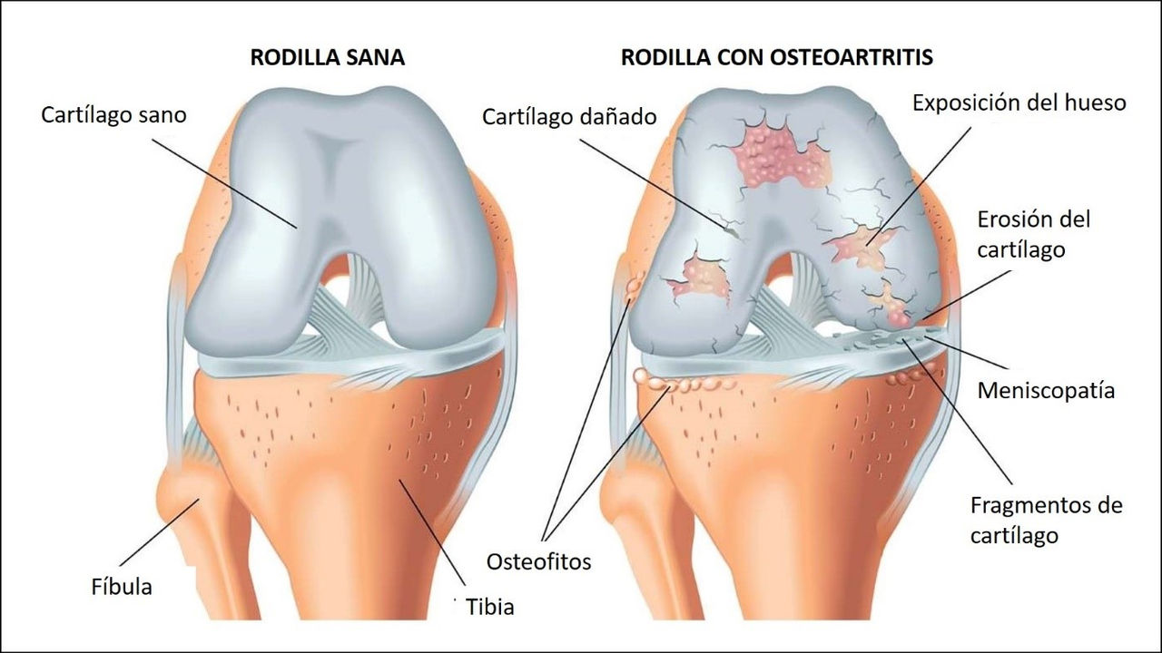 Osteoartritis